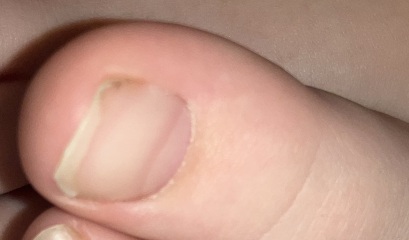 Ingrown toe nail?