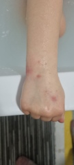 Rash - chicken pox or something else?