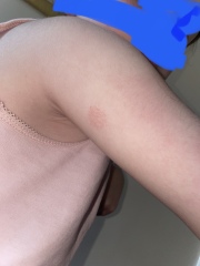 Eczema or ringworm? Pics attached