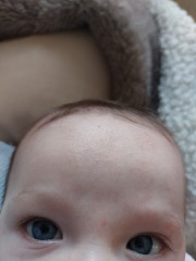 Cradle cap or eczema???
