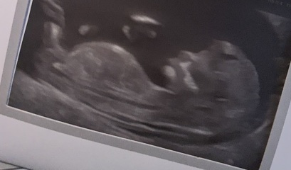 Nub theory. 12 week scan boy or girl?