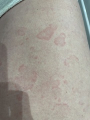 Is this an autoimmune issue