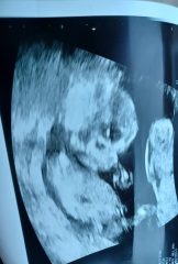 14ish week scan any guesses on whether baby is a boy or girl?