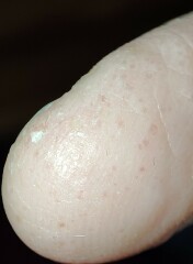 Hand eczema/pompholyx . Help! Trying to wean off steroid but keep reflaring!