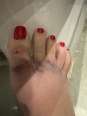 Broken toe? Foot?
