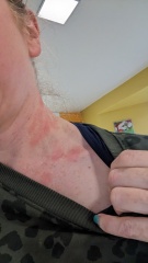 I've woken up with a rash on my neck. Pics included.