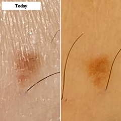 They postponed my appointment with the dermatologist 3 times. I don’t know what to do with this mole!