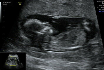 Is there a nub in this scan pic?