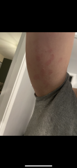 Is this an autoimmune issue
