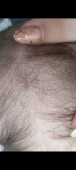 Cradle cap or eczema???