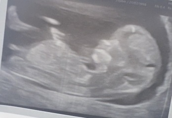 Nub theory. 12 week scan boy or girl?