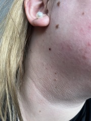 To think this is melanoma