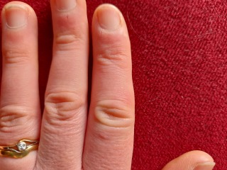 Chilblain (finger) or something else