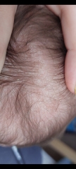 Cradle cap or eczema???