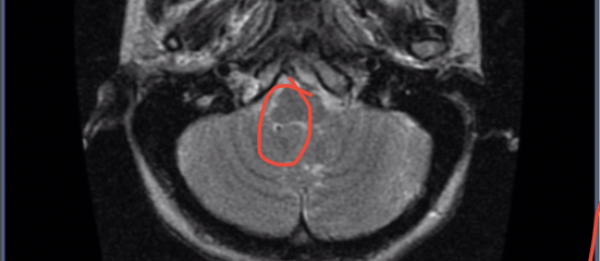 anyone know this?Brain MRI question?