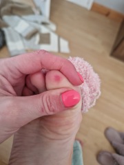 Sore red patched on toes ? Anyone any clued