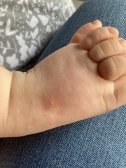 Is this hand foot and mouth?