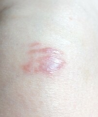What is happening to my scars?