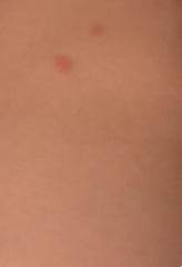 Spots? Bites? What are these?