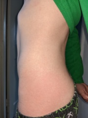 Could this be scarlet fever? DD gone to A&E