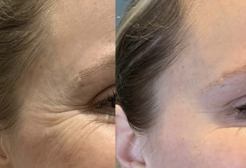 Botox is it worth it?