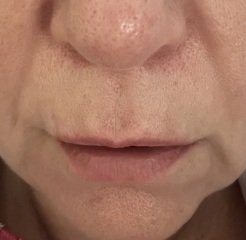 Help my lines and lips!! Pic attached…