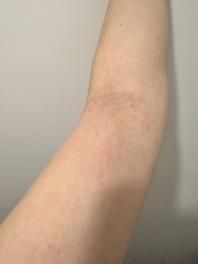 Rash