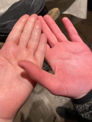 Raynauds