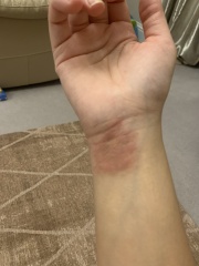 Hand eczema/pompholyx . Help! Trying to wean off steroid but keep reflaring!