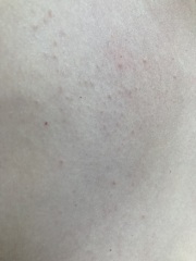 Spots on chest