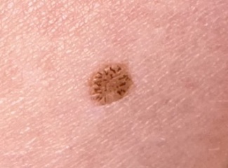 Freckle/mole. Anything to worry about?