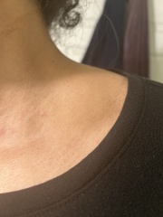 What is this swelling above my collar bone.
