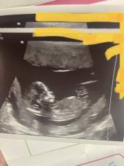 13 weeks scan Boy or girl?