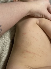 Rash