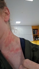 I've woken up with a rash on my neck. Pics included.