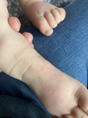Is this hand foot and mouth?