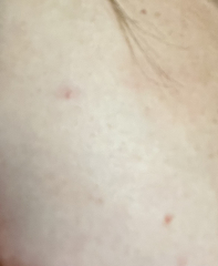 Petechiae or cherry angioma? Talk me down