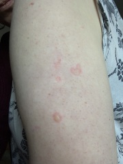 Does this look like shingles?