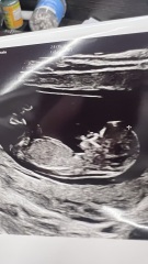 nub/skull  for 12weeks scan guess boy or girl