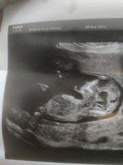 Boy or girl? 12 weeks scan