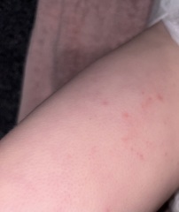 Can anyone help? No idea what this rash is