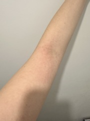 Rash