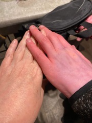 Raynauds