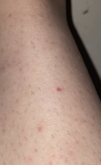 I have folliculitis on my lower left leg, and some red freckles on my right leg? Is this cause for concern?
