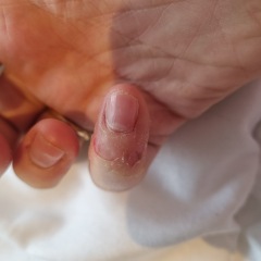 Skin picking (pics included)