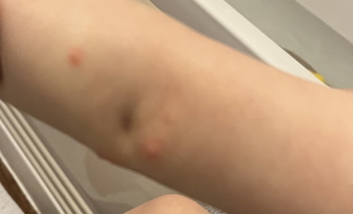 Does this look/sound like eczema?