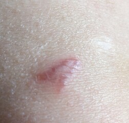 What is happening to my scars?