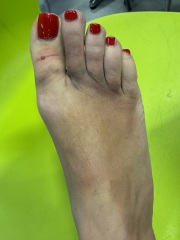 Broken toe? Foot?