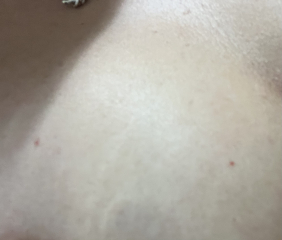 Petechiae or cherry angioma? Talk me down