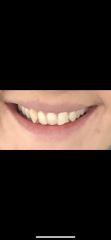 Braces in 30s?